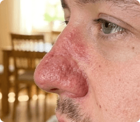 Šoninis profilis, rodantis odos sustorėjimą ir tekstūrą ant nosies. title.phimosis.form
