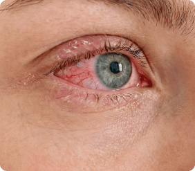 Ekstremalus stambaus planas su uždegusia, krauju pasruvusia akimi. title.ophthalmic.form