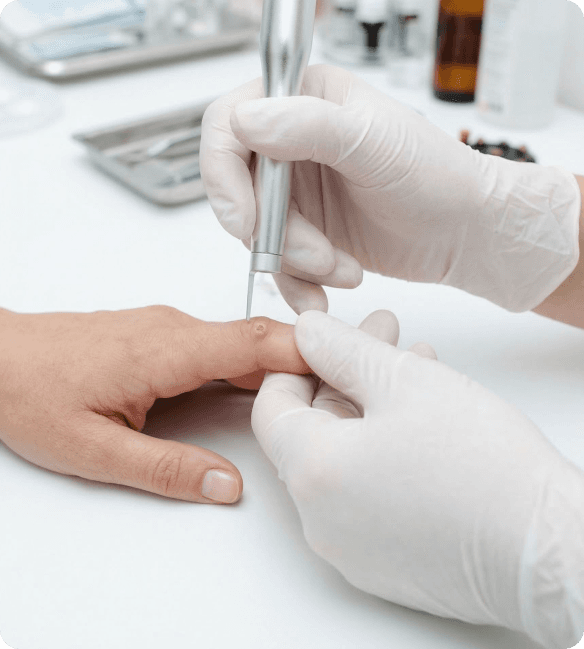 Dermatologinė procedūra, šalinanti gerybinį odos augimą Ryški, iš arti nuotrauka, kurioje užfiksuotas tikslinis dermatologinis įrankis, kurį gydytojas naudoja mažam, lokalizuotam odos pažeidimui paciento odos paviršiuje gydyti arba pašalinti.