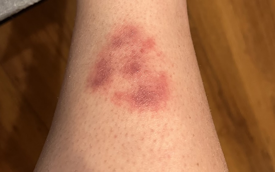 Expanding skin redness (erythema migrans) after a tick bite