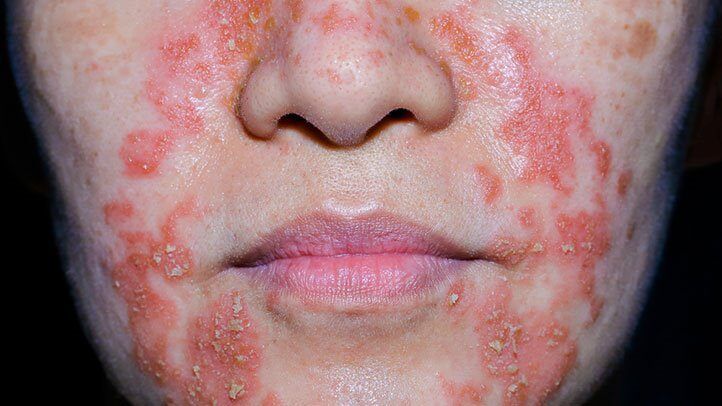Schwere periorale Dermatitis mit Rötung und Schuppung um Mund und Nase