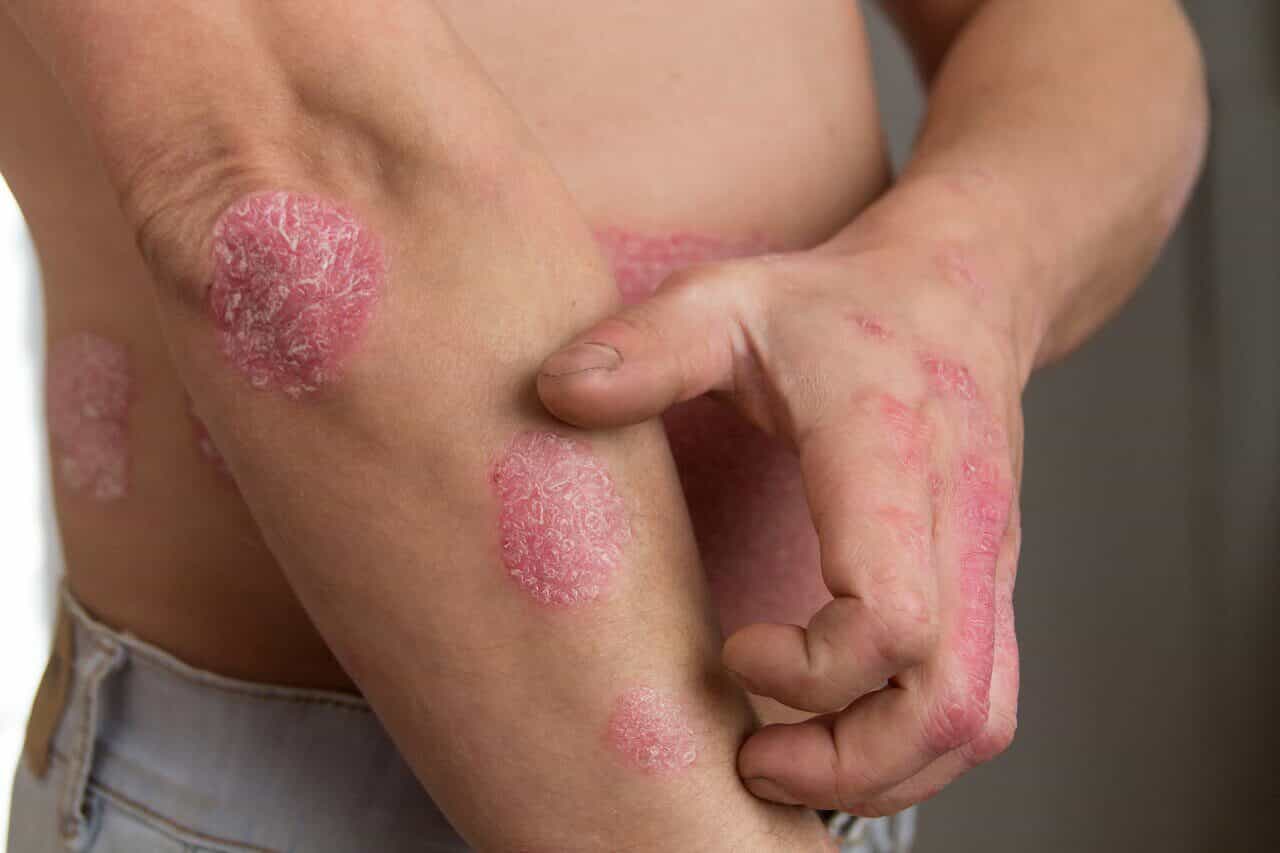 Psoriasis am Ellbogen: scharf begrenzte rote Flecken mit silbrigen Schuppen