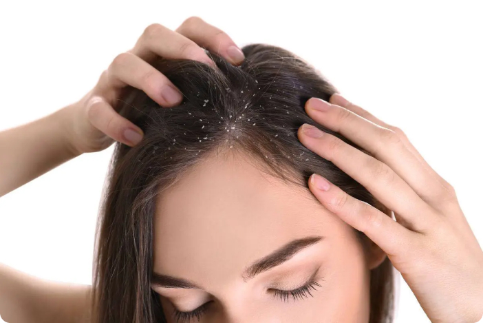 Seborrhoische Dermatitis: fettige, gelbliche Schuppung und Rötung an den Augenbrauen und um die Nase